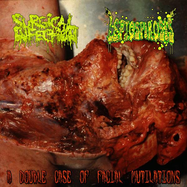Surgical Infection - Discography