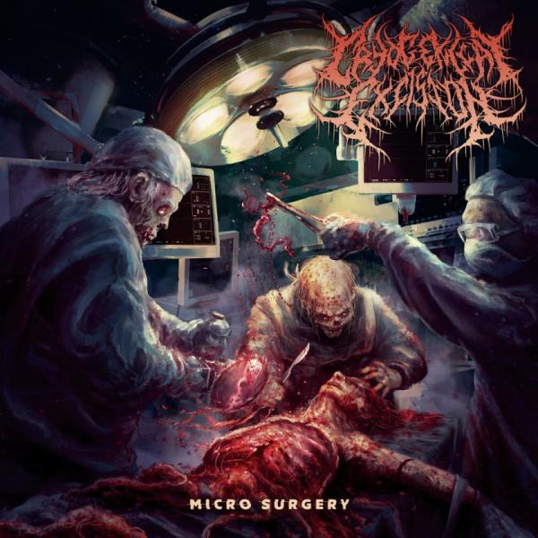 Cryogenical Excision - Micro Surgery (EP)