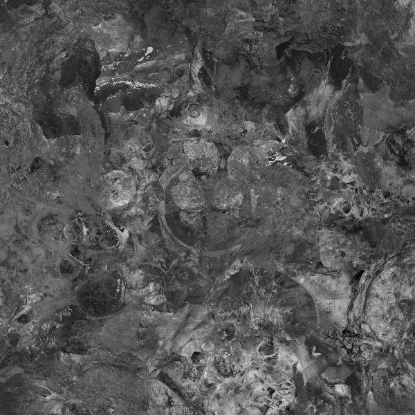 Acute Nephritis - Renal Cell Carcinoma (Demo)